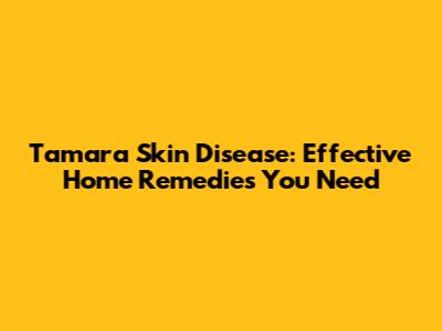 Tamara Skin Disease: Effective Home Remedies You Need